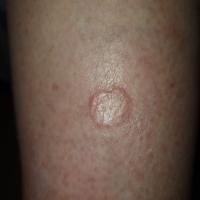 Porokeratosis
Copied with kind permission from…