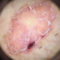 Porokeratosis
Copied with kind permission from…