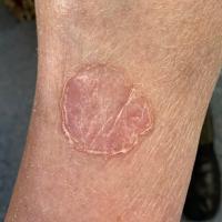 Porokeratosis