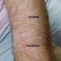 
	Porokeratosis&nbsp;

	Copied with kind…