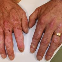 
	Porphyria cutanea tarda - secondary to…
