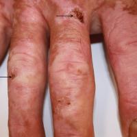 
	Close-up of figure 3

	Healing blisters…