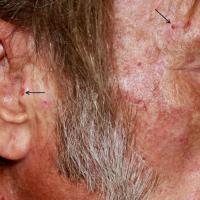 
	Same patient as previous image - face involved