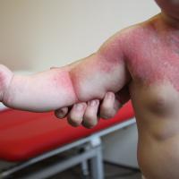 
	Klippel-Trenaunay syndrome

	Image copied with…