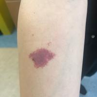 Port-wine stain - localised on arm
No action…