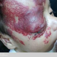 Port-wine stain as part of the&nbsp;Sturge-Weber…