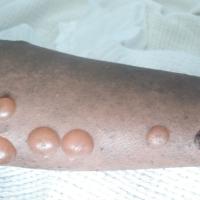 
	Pemphigoid gestationis

	&nbsp;