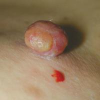 
	Pyogenic granuloma