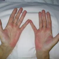
	Palmar erythema