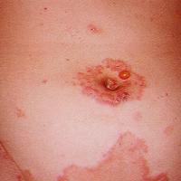 
	Pemphigoid gestationis

	Copied with kind…