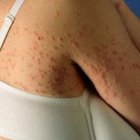 
	Prurigo of pregnancy