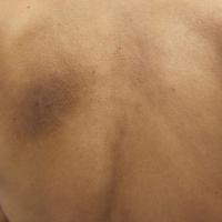 
	Notalgia paraesthetica