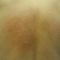 
	Notalgia paraesthetica