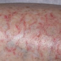 
	Asteatotic eczema: close-up