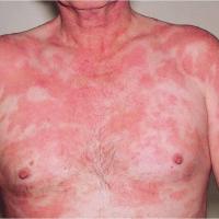 
	Cutaneous t-cell lymphoma (CTCL)
	Lesions…