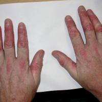 
	Psoriasis affecting hands