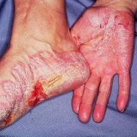 
	Psoriasis 