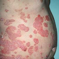 
	Large plaque psoriasis

	Large plaques and…
