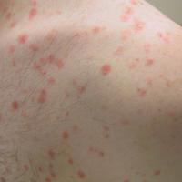 
	Small plaque psoriasis
	
	Lesions are thinner…