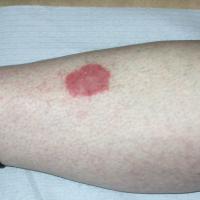
	A solitary plaque of psoriasis
	
	If this…