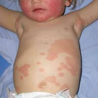 
	Childhood psoriasis
	
	Diagnosing psoriasis in…