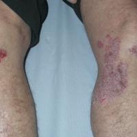 
	Large plaque psoriasis on the knees