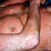 
	Generalised pustular psoriasis
	
	Copied with…