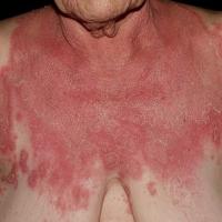 
	Generalised pustular psoriasis
	
	Copied with…