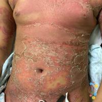 Generalised pustular&nbsp;psoriasis&nbsp;
Copied…