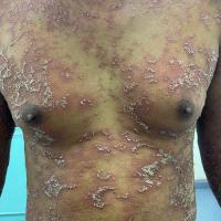 Pustular psoriasis&nbsp;
Copied with kind…