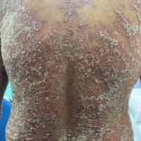 Pustular psoriasis - same patient as previous…
