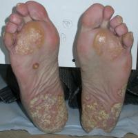 
	Hyperkeratotic psoriasis affecting the…
