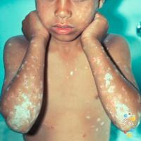 Chronic plaque psoriasis&nbsp;
Copied with kind…