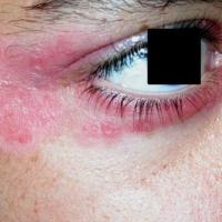 
	Psoriasis in a child
	
	Well-defined plaque