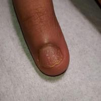 Nail psoriasis - pitting
Copied with kind…
