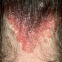 
	Scalp psoriasis affecting the posterior scalp…