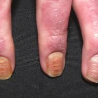
	Psoriatic arthritis

	Nails and joints affected…
