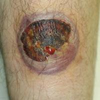 
	Bullous PG

	A haemorrhagic bulla has resulted…