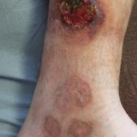 
	PG

	The lesions underneath have healed with…