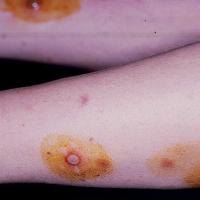 
	Pustular PG

	The brown discolouration&nbsp;is…