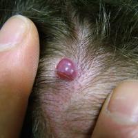 
	Pyogenic granuloma on the scalp