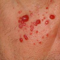 
	Eruptive pyogenic granuloma
	
	Multiple lesions…