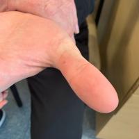 Same patient as previous image&nbsp;- 2 weeks of…