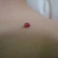 
	Pyogenic granuloma on the shoulder of a 12 year…
