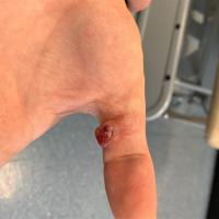 Pyogenic granuloma