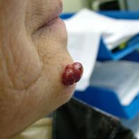 
	Pyogenic granuloma in an elderly woman