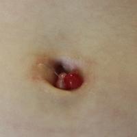 
	Pyogenic granuloma in the newborn 