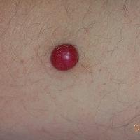 
	An amelanotic melanoma
	
	There was no history…