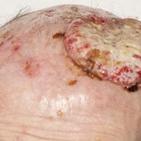 
	Skin cancer treated with palliative…