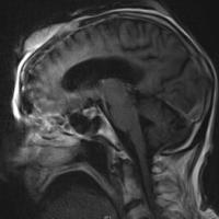 
	MRI scan of the previous image showing…